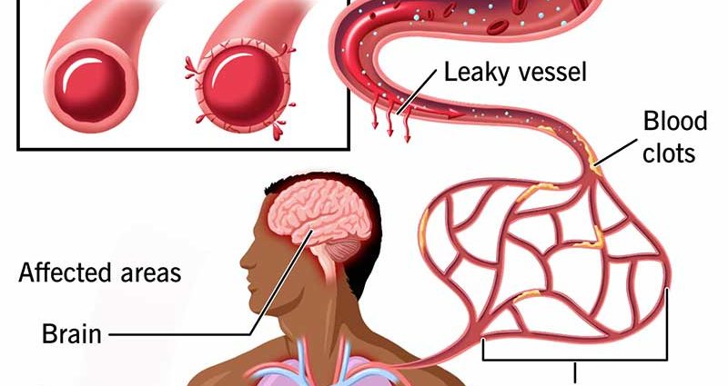 Sepsis &#8211; what it is, symptoms, treatment. How can you get infected? WE EXPLAIN