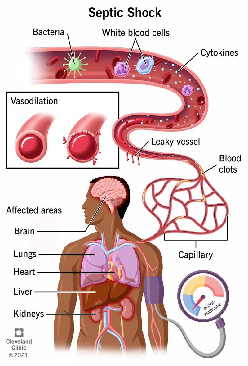 Sepsis &#8211; what it is, symptoms, treatment. How can you get infected? WE EXPLAIN