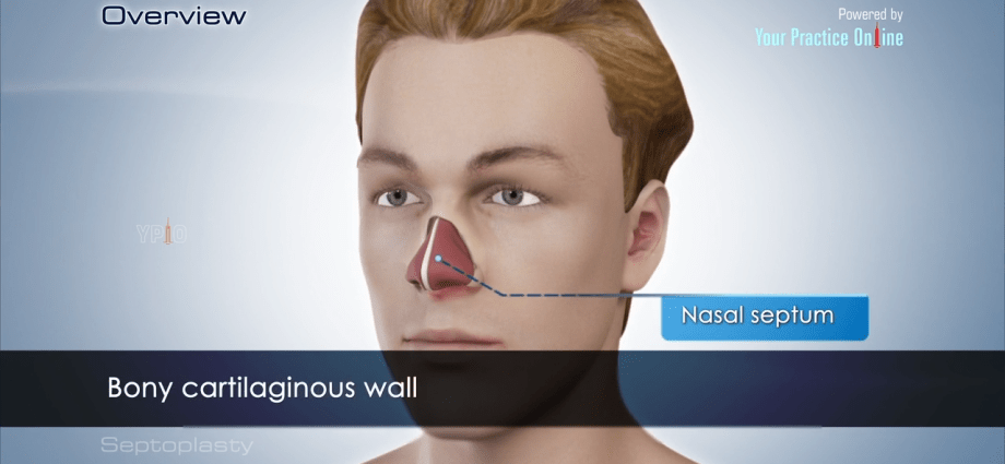 Septoplasty &#8211; indications for surgery. What does the correction of a deviated nasal septum look like?