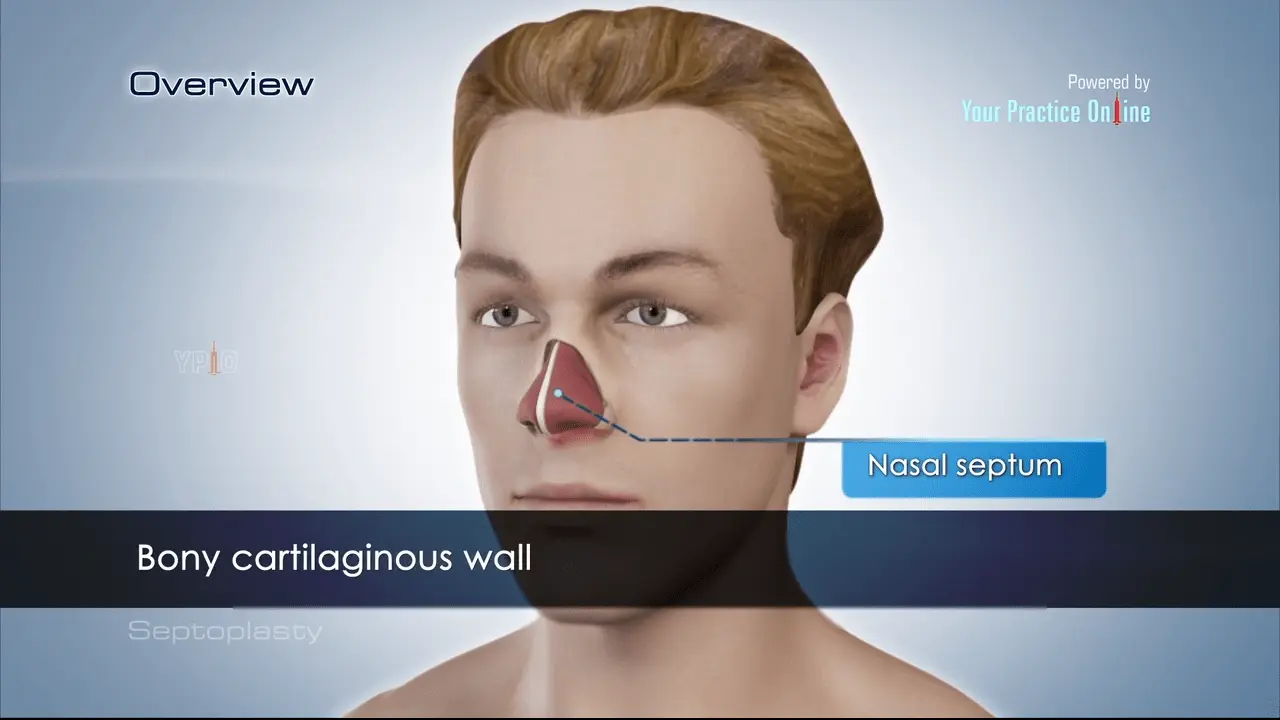 Septoplasty &#8211; indications for surgery. What does the correction of a deviated nasal septum look like?