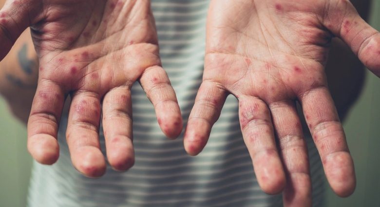 Seven diseases that can be seen on the hands