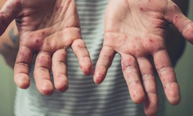 Seven diseases that can be seen on the hands