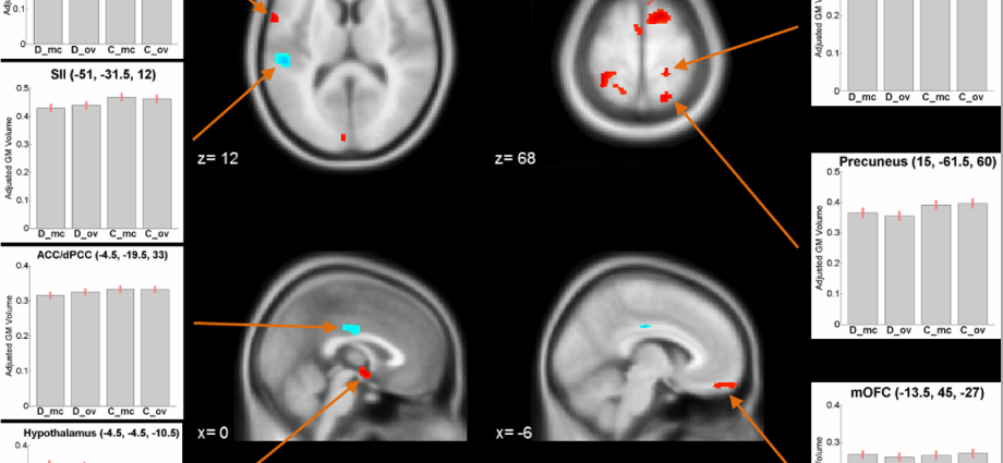 Severe period pains change the structure of the brain