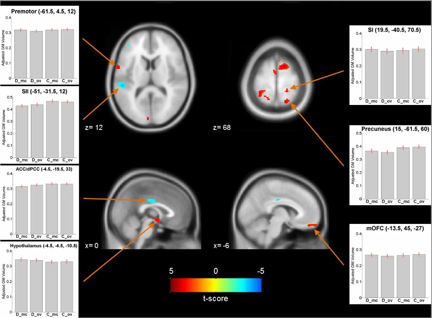 Severe period pains change the structure of the brain