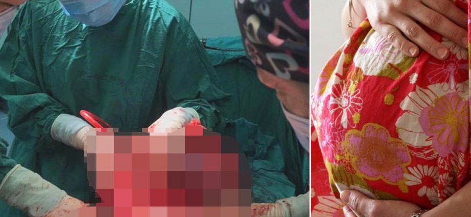 She thought she had gained weight. It turned out she had a 15 kg tumor in her belly