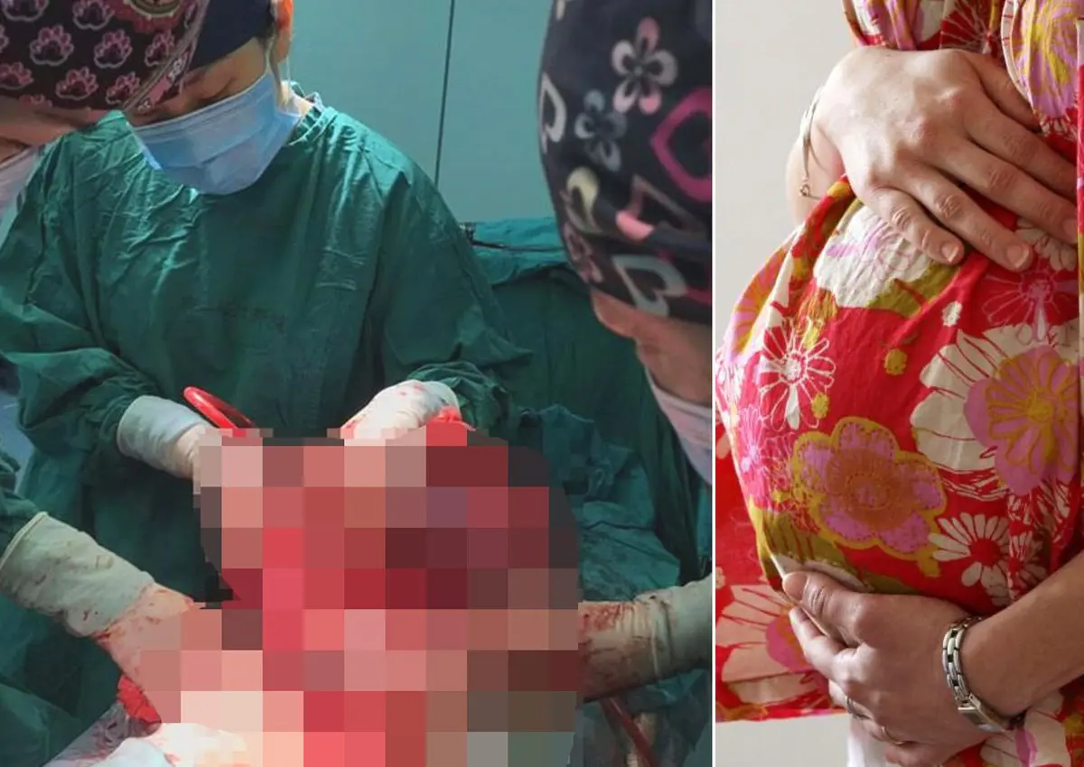 She thought she had gained weight. It turned out she had a 15 kg tumor in her belly