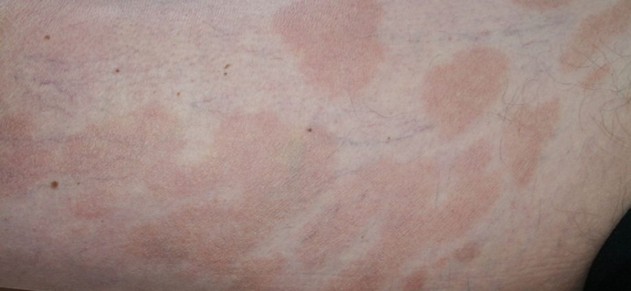 Shearing mycosis &#8211; how does it manifest itself? What is the treatment like?