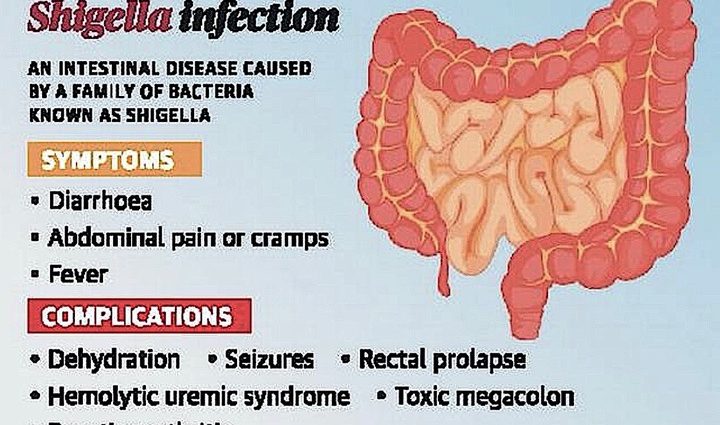 Shigella &#8211; causes, symptoms and treatment of Shigella infection