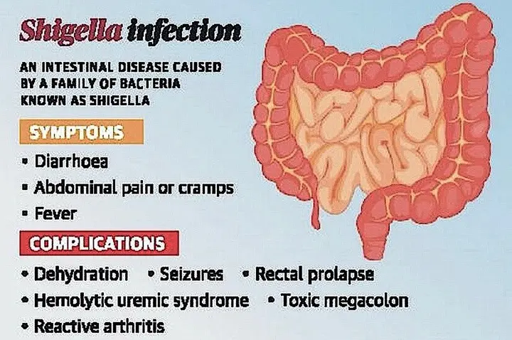 Shigella &#8211; causes, symptoms and treatment of Shigella infection