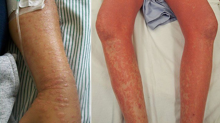 Shin mycosis &#8211; chronic mycosis typical for women