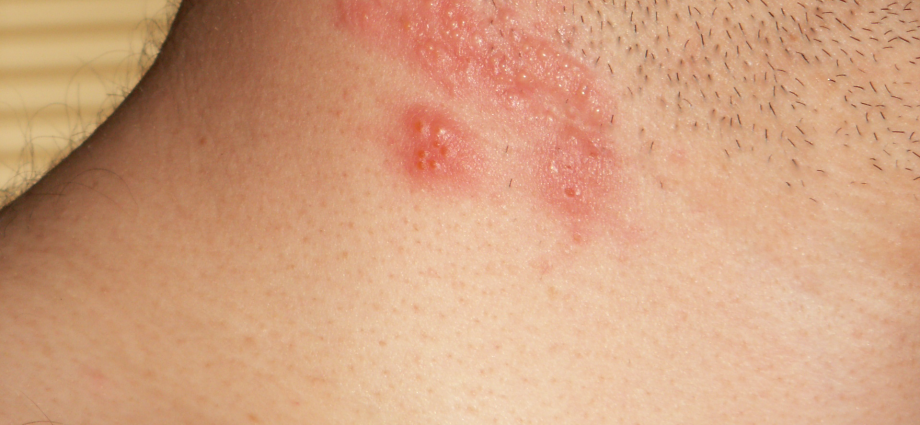 Shingles &#8211; a painful infectious disease. What causes it?