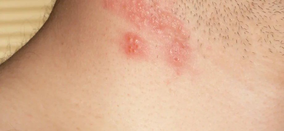 Shingles &#8211; how to recognize the disease?