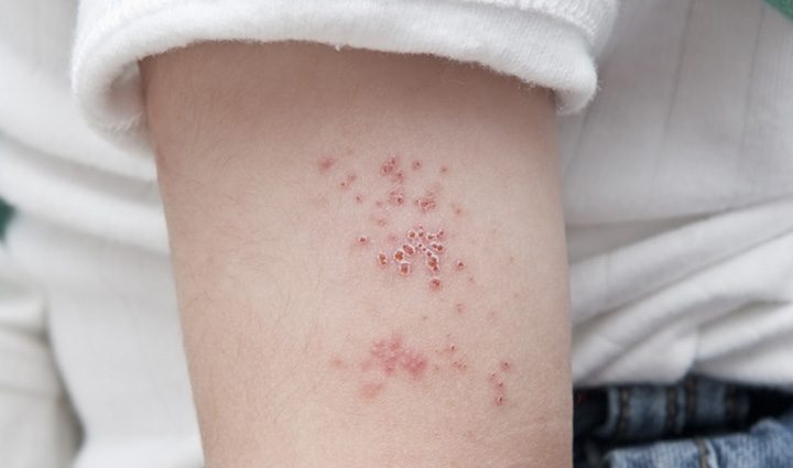 Shingles in children &#8211; causes, symptoms, treatment