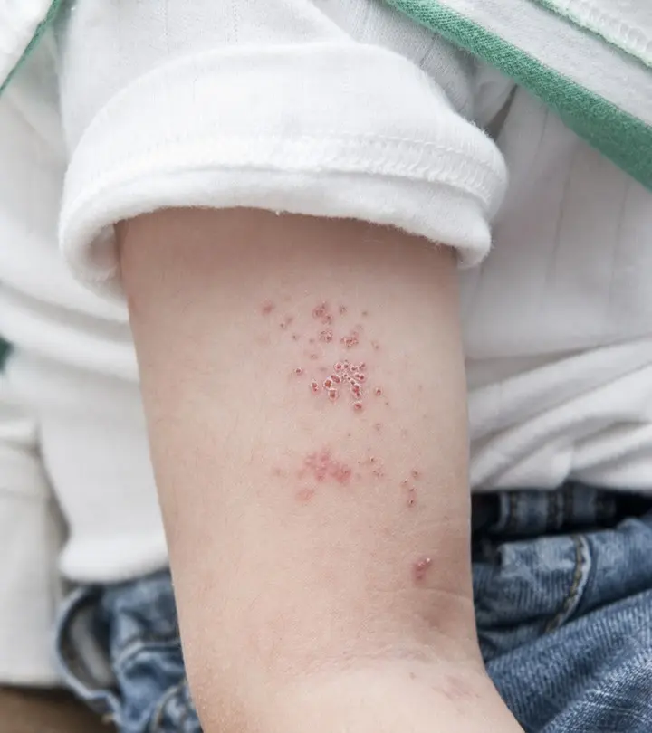 Shingles in children &#8211; causes, symptoms, treatment