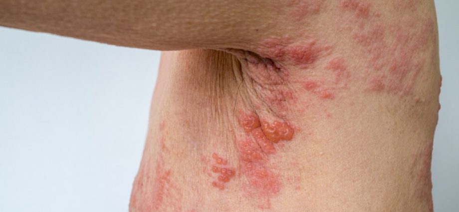 Shingles &#8211; symptoms, treatment, complications. How can you get infected? [EXPLAIN]