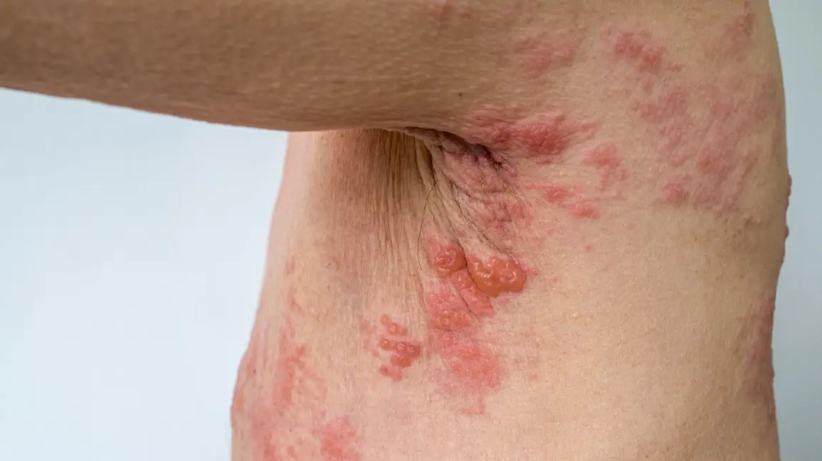 Shingles &#8211; symptoms, treatment, complications. How can you get infected? [EXPLAIN]