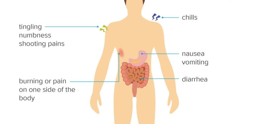 Shingles &#8211; Will I Get Additional Symptoms?