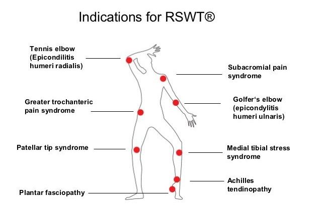 Shockwave &#8211; indications, course and effects. When should you opt for a shockwave?