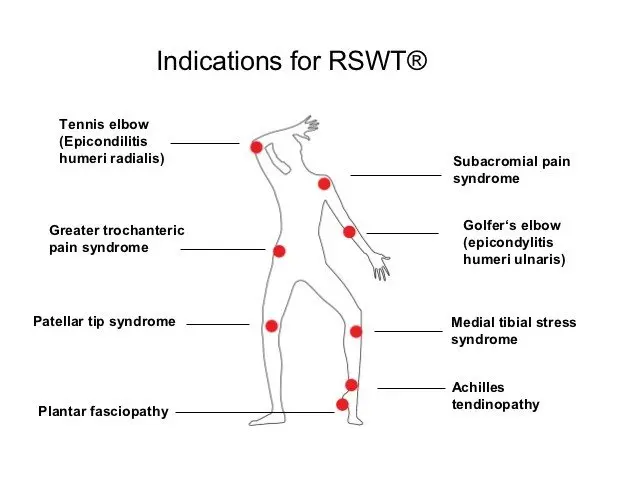 Shockwave &#8211; indications, course and effects. When should you opt for a shockwave?