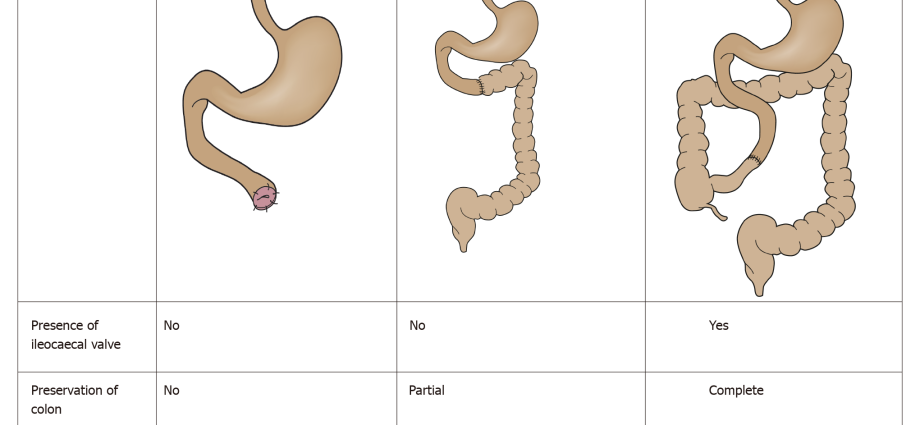 Short bowel syndrome &#8211; diagnosis and treatment