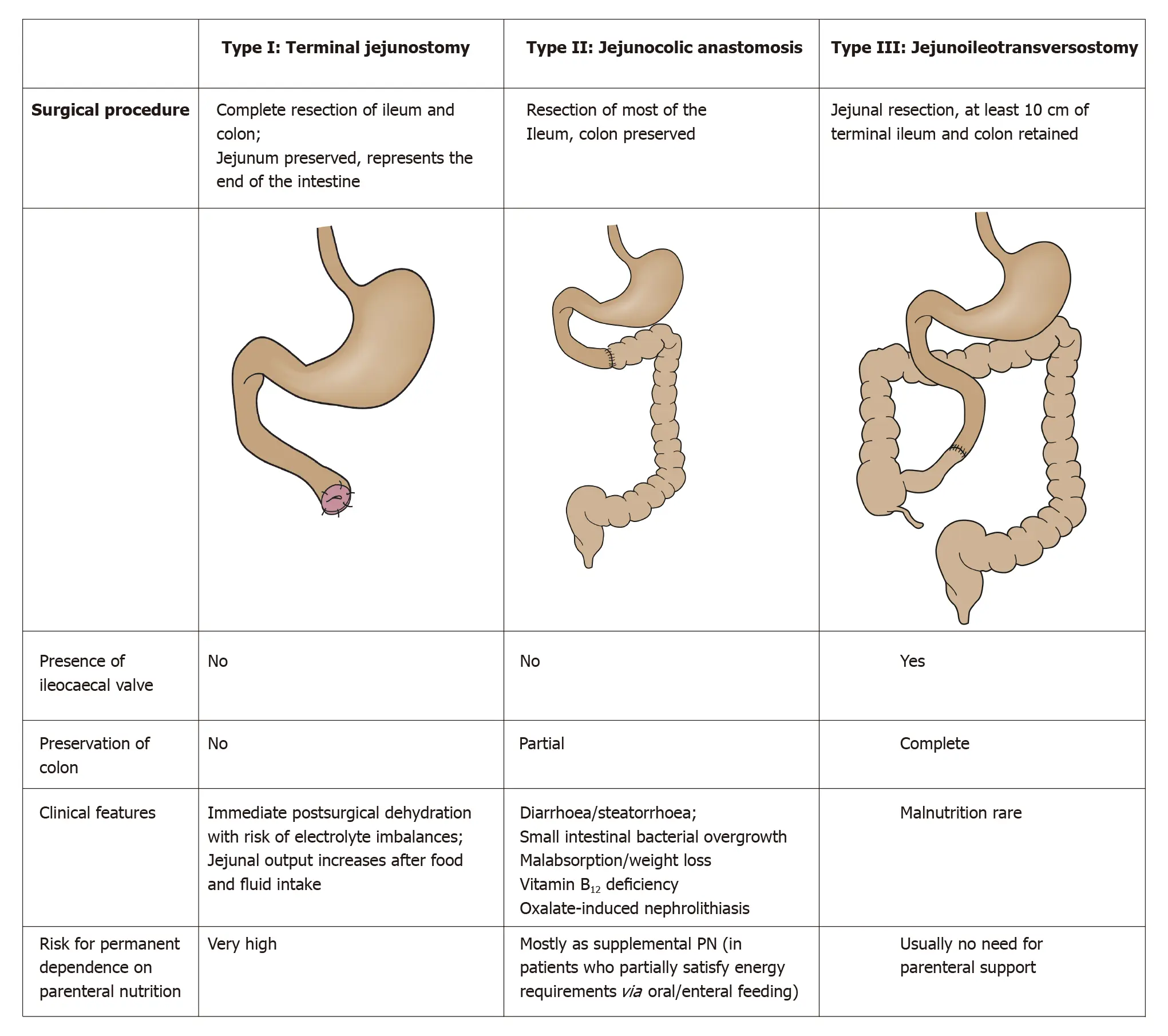 Short bowel syndrome &#8211; diagnosis and treatment