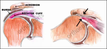 Shoulder isthmus syndrome &#8211; causes, treatment