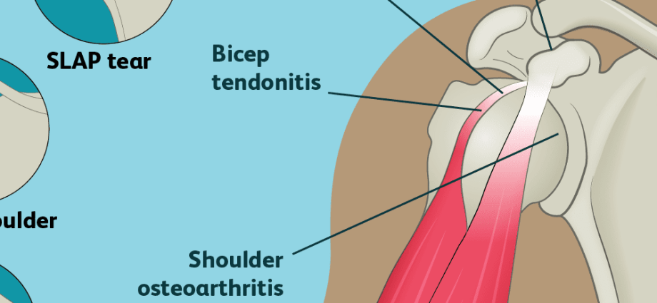 Shoulder pain &#8211; causes, diagnosis, treatment. The most common diseases of the shoulder