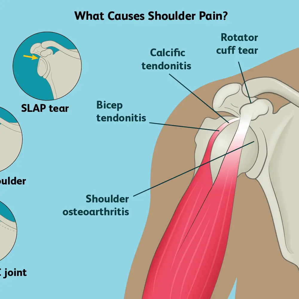 Shoulder pain &#8211; causes, diagnosis, treatment. The most common diseases of the shoulder