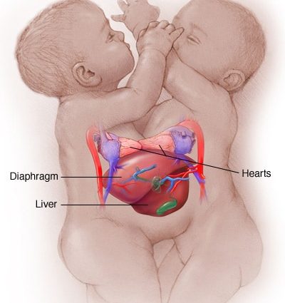 Siamese twins &#8211; causes, symptoms and course of the developmental defect