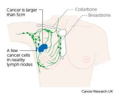 Side effect after the third dose. Swollen lymph nodes are similar to those of breast cancer. Doctors calm down