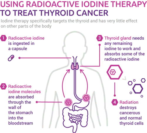 Side effects of the administration of radioactive iodine