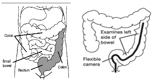 Sigmoidoscopy &#8211; endoscopic examination of the large intestine. Indications, course and possible complications of the examination