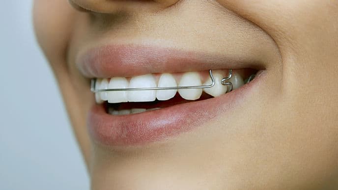 Simple and beautiful teeth without braces!