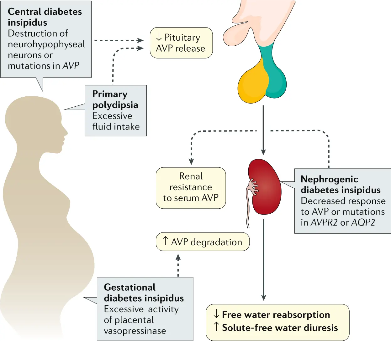 Simple diabetes insipidus &#8211; causes, symptoms, treatment