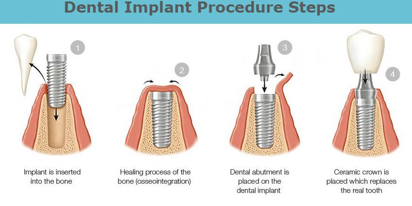 Single-phase and two-phase implants. Which dental implants to choose?