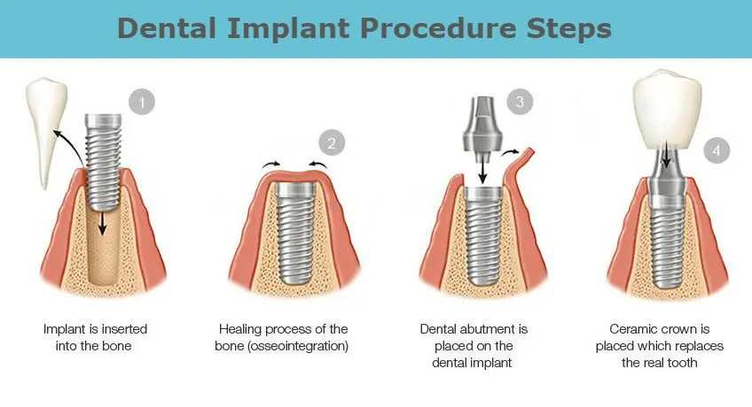 Single-phase and two-phase implants. Which dental implants to choose?