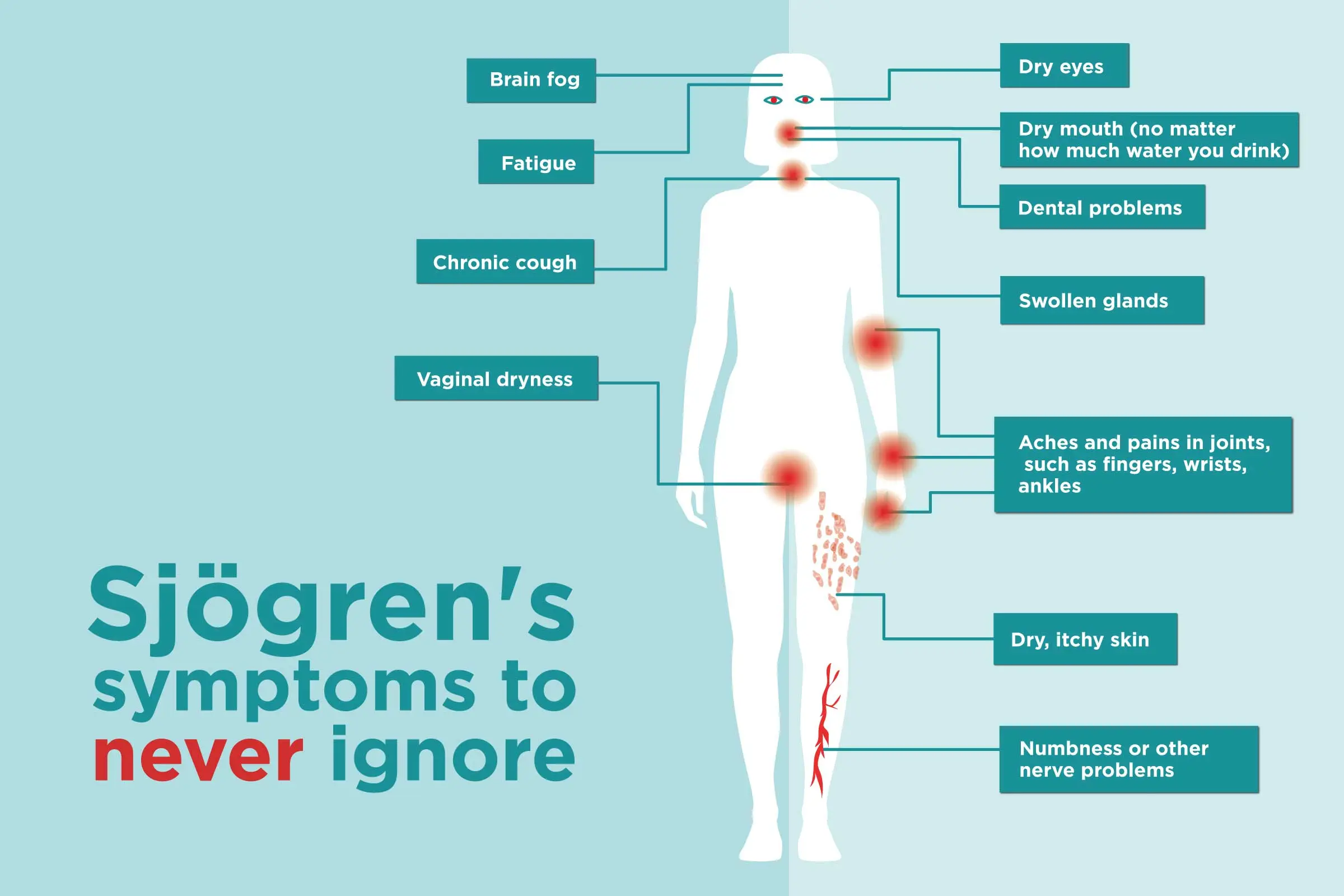 Sjögren&#8217;s syndrome &#8211; causes, symptoms, treatment. Living with Sjögren&#8217;s syndrome