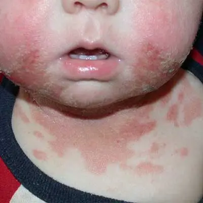 Skin allergy in children &#8211; causes, symptoms, skin care