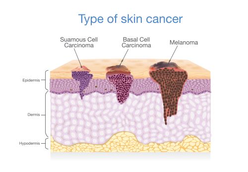 Skin cancer &#8211; symptoms, types and prevention of skin cancer