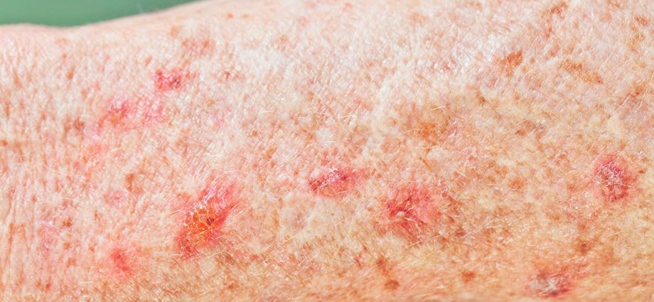 Skin diseases. What do you need to know about them?