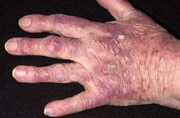 Skin lesions in internal diseases