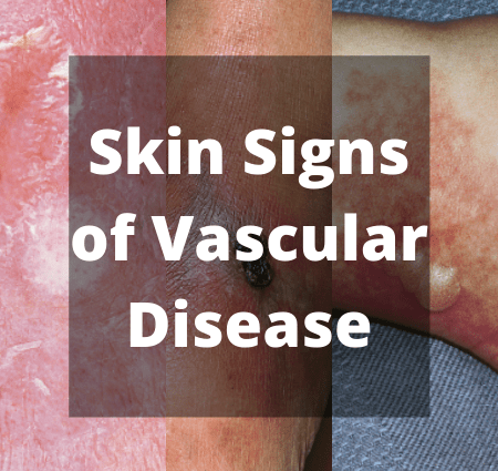 Skin lesions related to vascular disorders