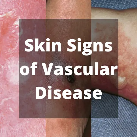 Skin lesions related to vascular disorders