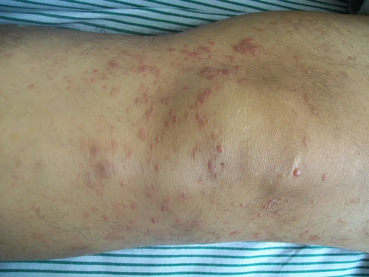 Skin mycosis &#8211; symptoms, treatment. Brown spots on the skin