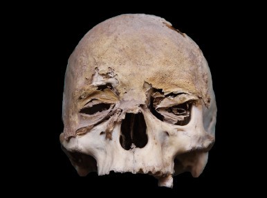 Skull trepanation &#8211; indications, recovery and possible complications