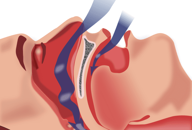 Sleep apnea associated with hearing loss