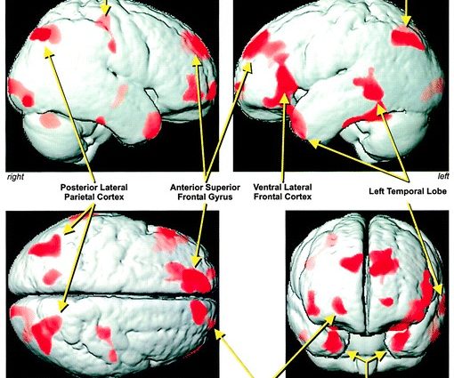 Sleep apnea increases the risk of brain damage