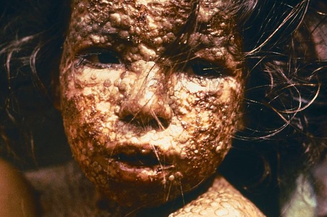 Small pox