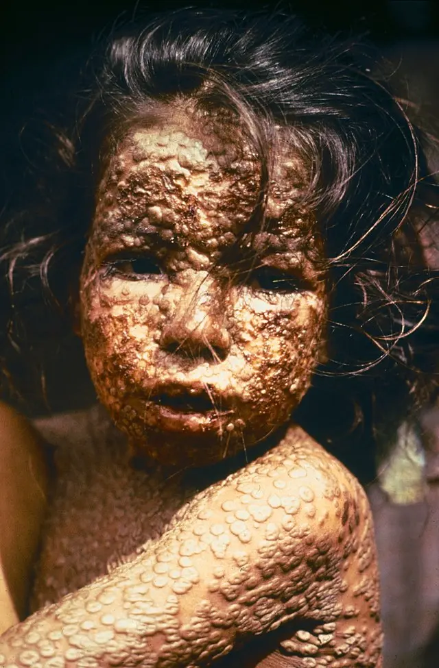 Small pox