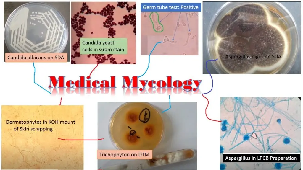 Small spore mycosis &#8211; appearance, diagnosis, treatment